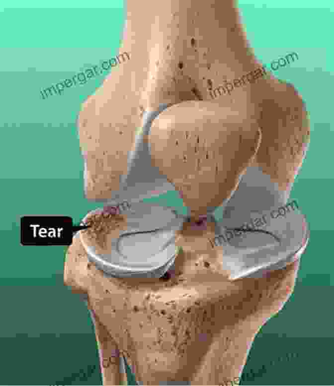 Diagram Of Knee Meniscus Cartilage Tear Knee Meniscus (Cartilage) Tears: Everything You Need To Know To Make The Right Treatment Decision